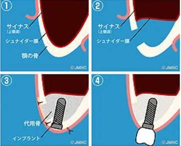 サイナスリフト