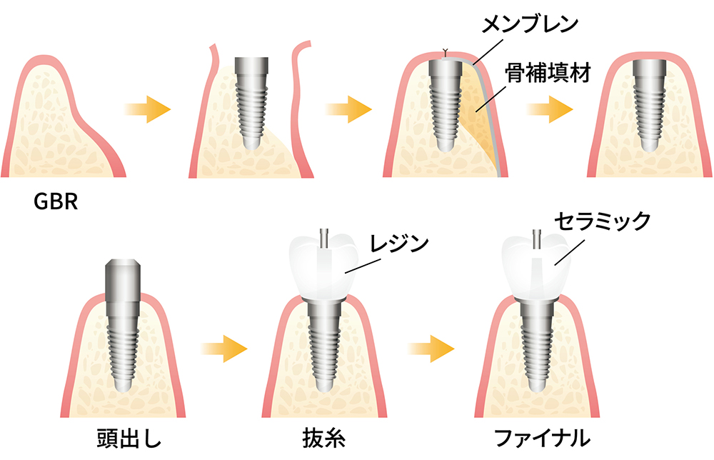 GBR法