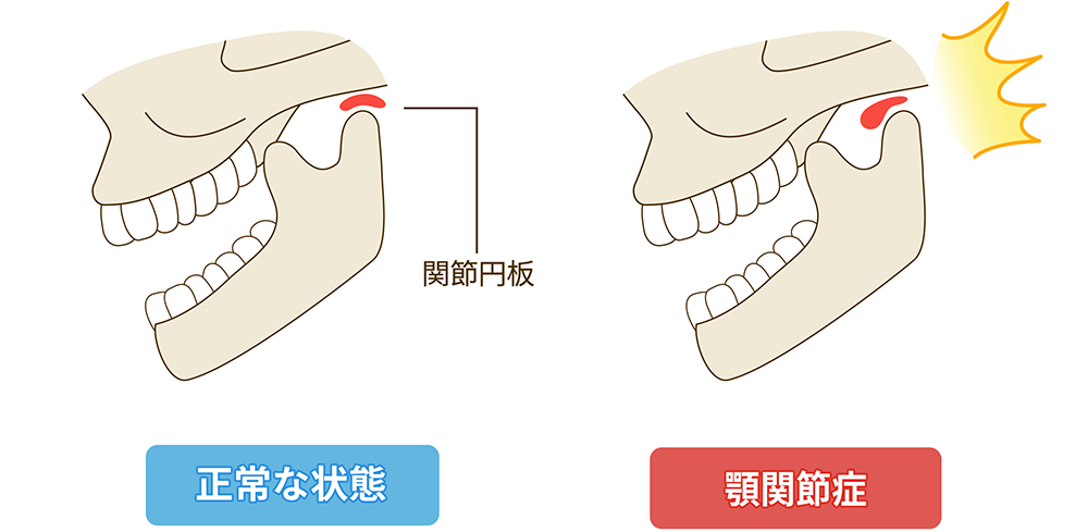 顎関節症