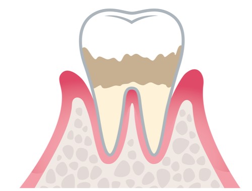 軽度歯周炎