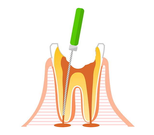 歯を残すための根管治療